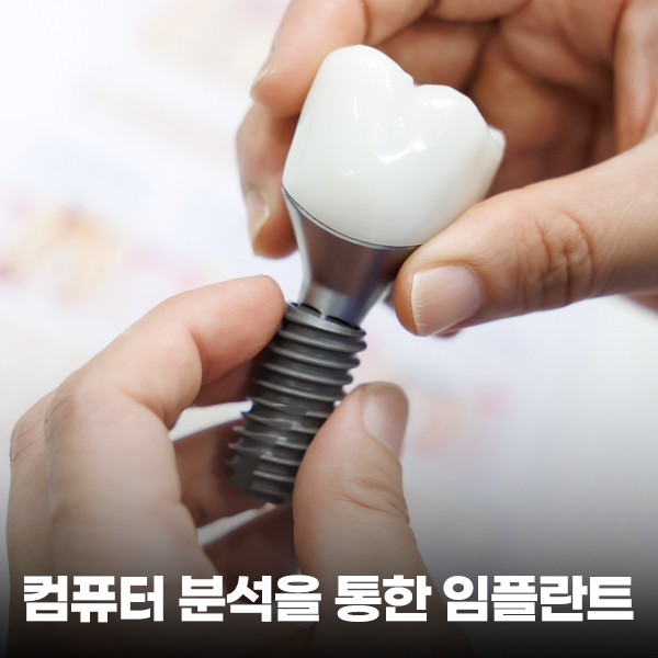 컴퓨터 분석을 활용한 임플란트 수술